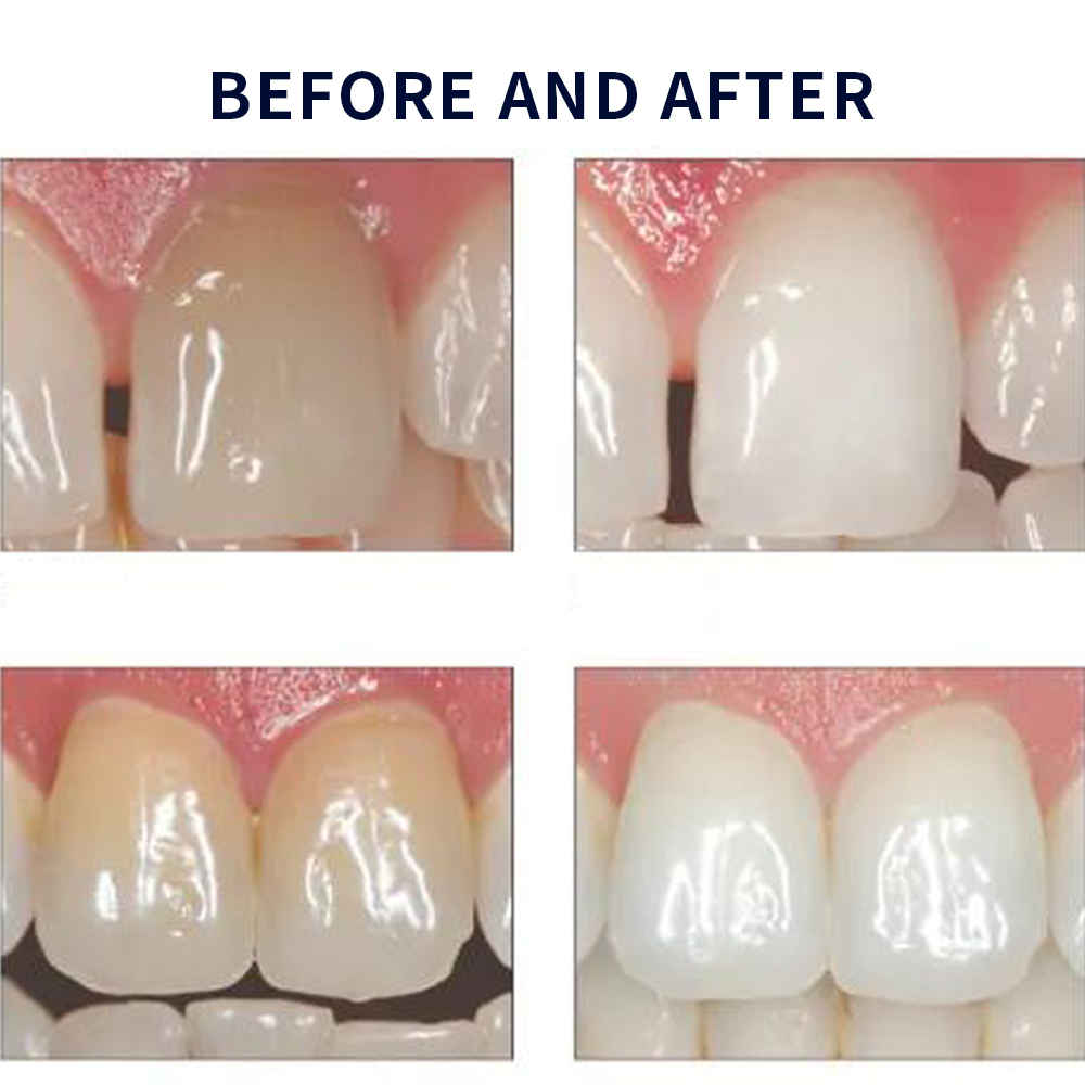 Opalescencia blanqueadora 20%  - Teeth Whitening Hismile reseña y precio