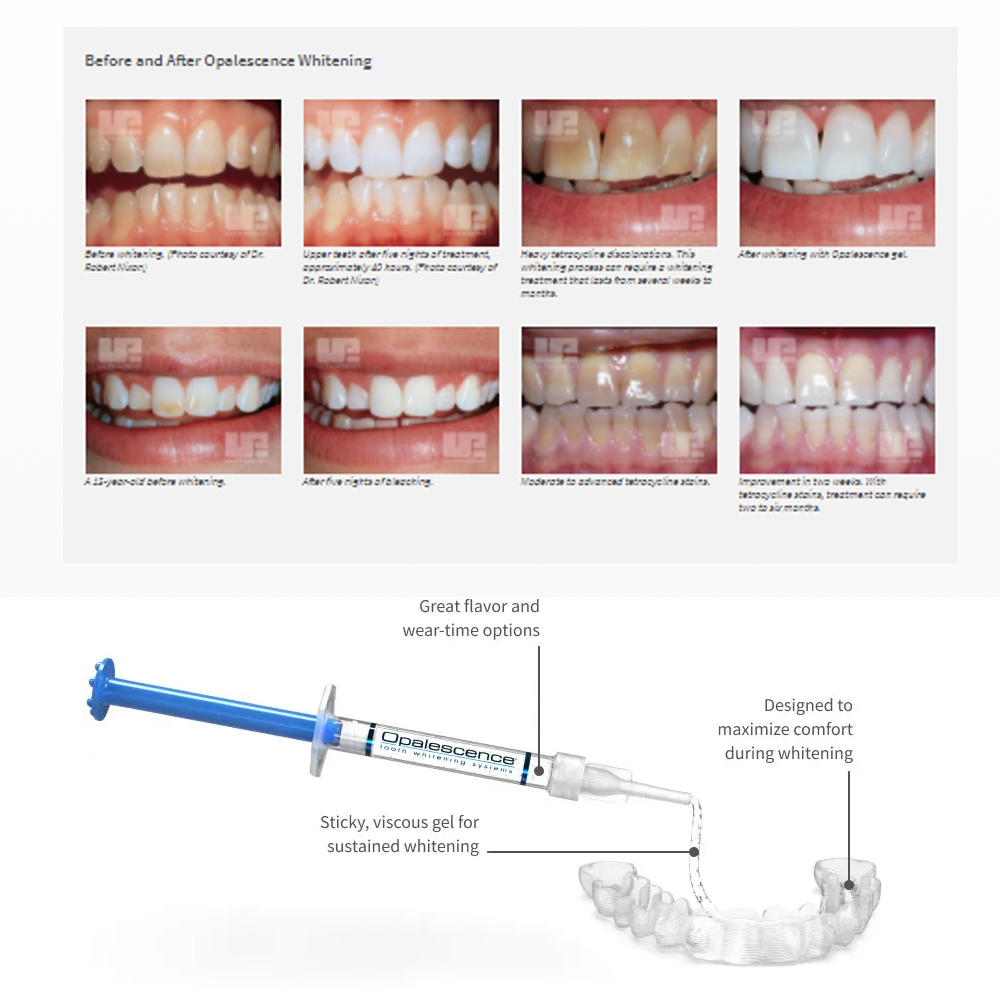 Opalescencia blanqueadora 20%  - Teeth Whitening Hismile reseña y precio