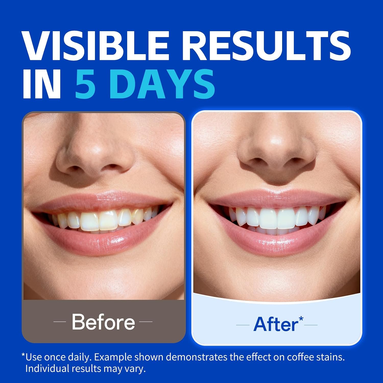 1/7 Pares de Tiras Blanqueador - Teeth Whitening Street reseña y precio